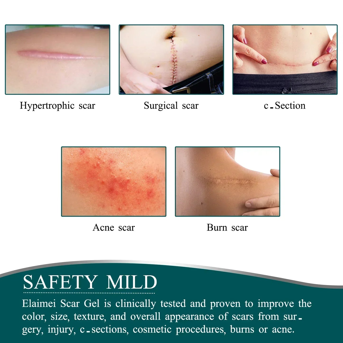ELAIMEI Wholesale Effective Skin Therapy Scar Treatment Roll Silicone Gel Scar Sheets for New and Old Scars Removal
