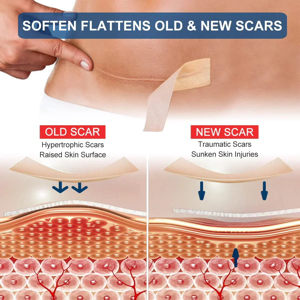 ELAIMEI Wholesale Effective Skin Therapy Scar Treatment Roll Silicone Gel Scar Sheets for New and Old Scars Removal